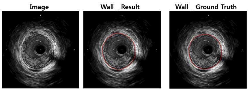 컨볼루션 신경망을 이용한 혈관내 초음파 영상에서의 혈관벽 및 루멘 영역화 방법 대표 이미지