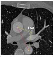 심장의 기하학적 정보를 이용한 좌심방이 검출방법 대표 이미지