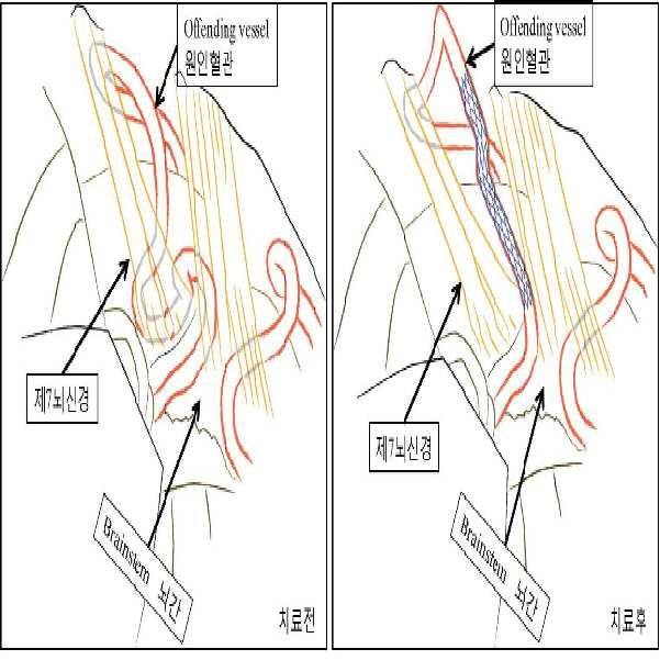 혈관성 신경압박 질환 치료용 스텐트 대표 이미지