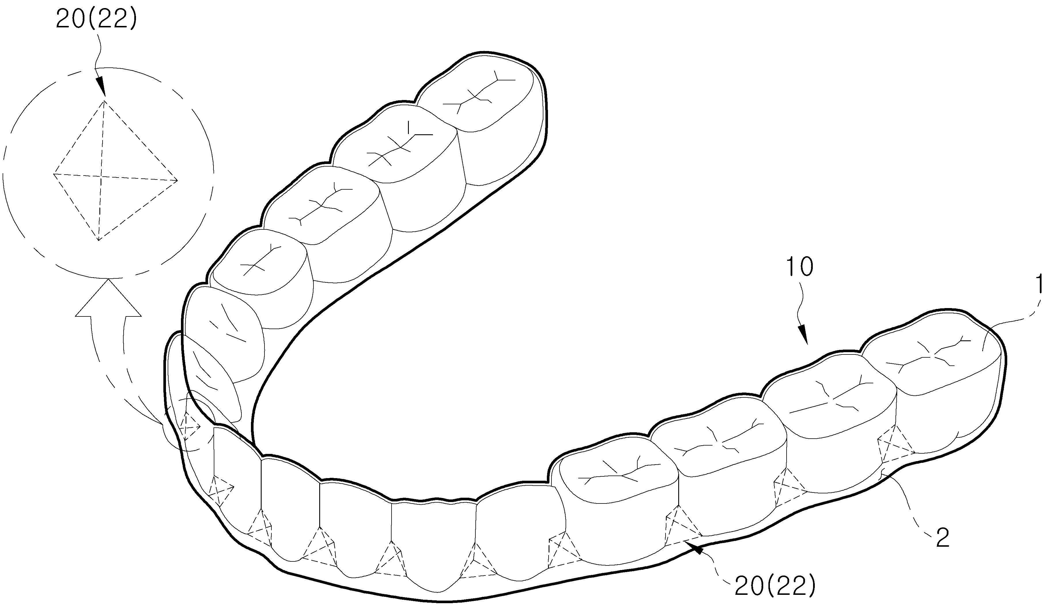 투명 치아 교정 장치 및 그 제조 방법 대표 이미지