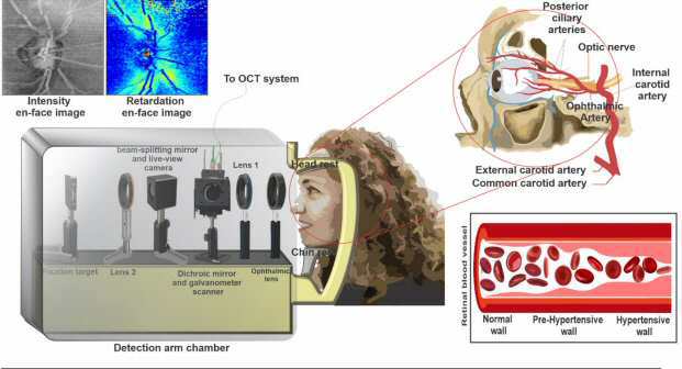 망막영상을 통한 고혈압 진단 기술 대표 이미지