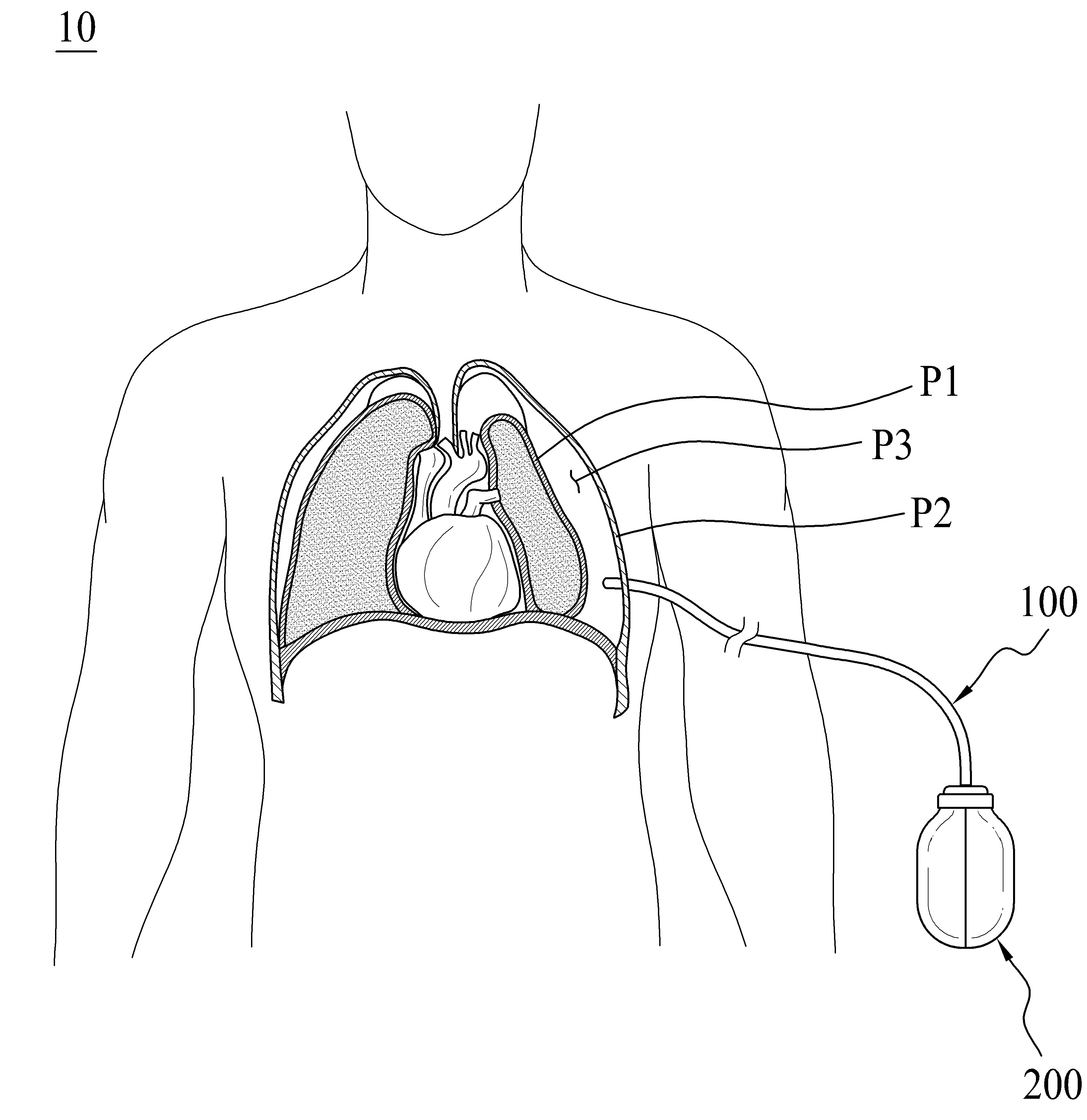 흉강 내압 확인기기 및 이에 포함되는 흉강 삽입장치 대표 이미지