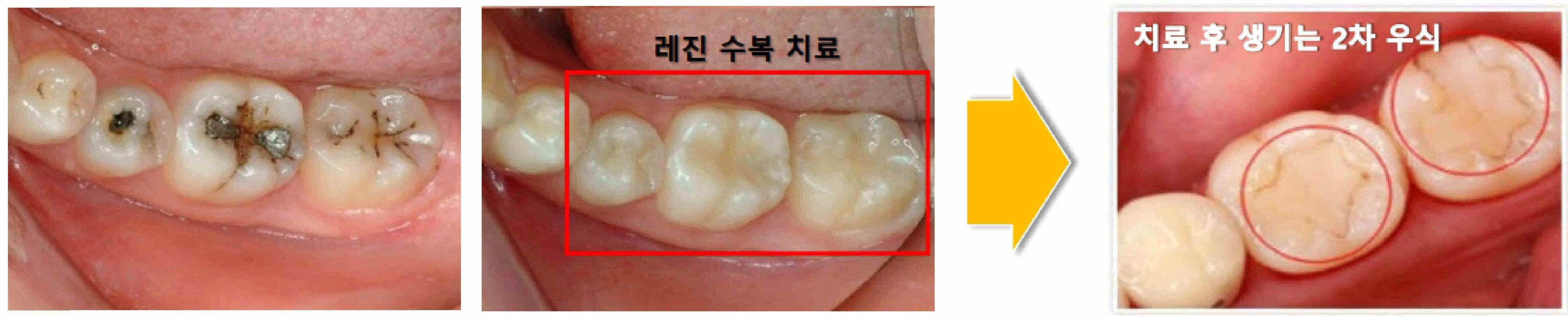 항균 효과를 가지는 치과용 복합레진 조성물 및 이의 제조방법 대표 이미지