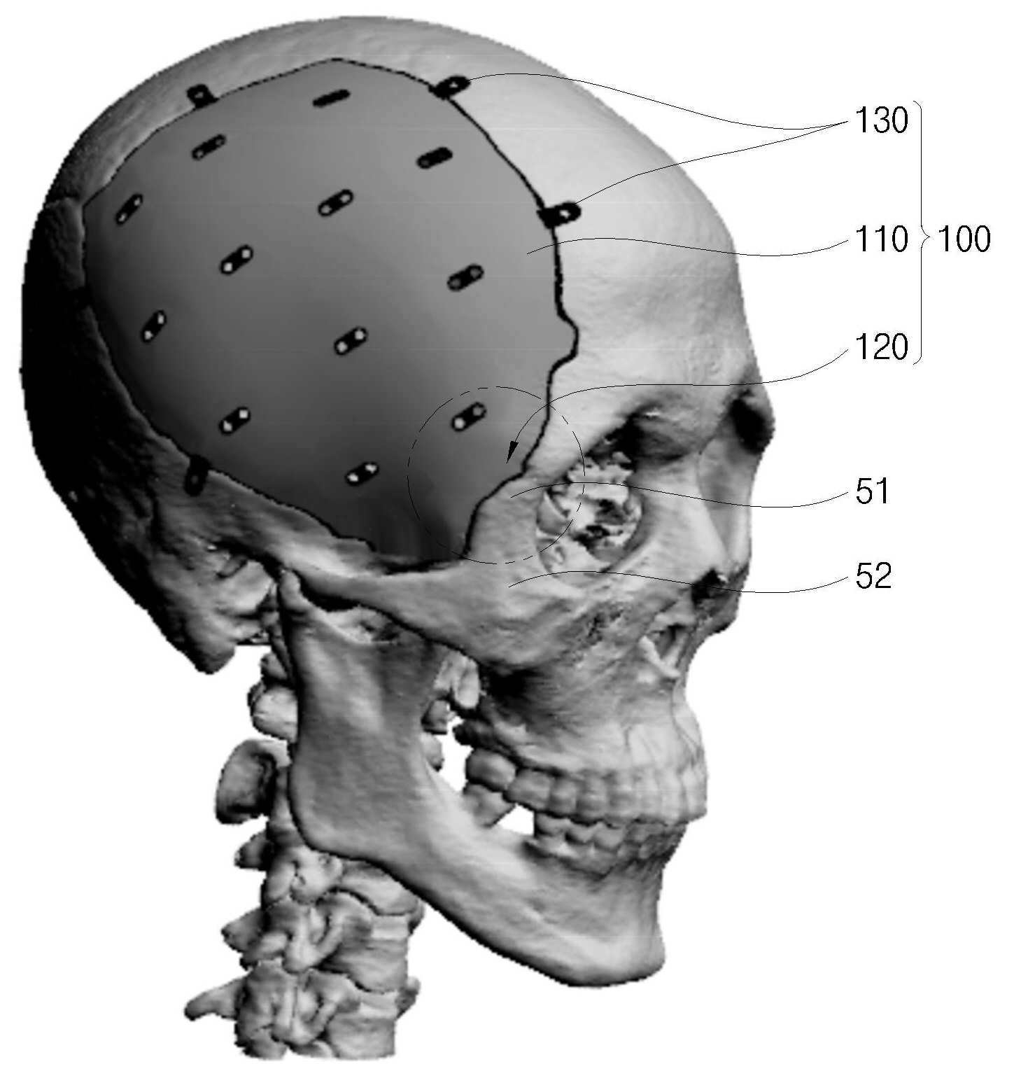 두개골 성형술에 사용되는 3차원 임플란트 및 이의 제작방법 대표 이미지