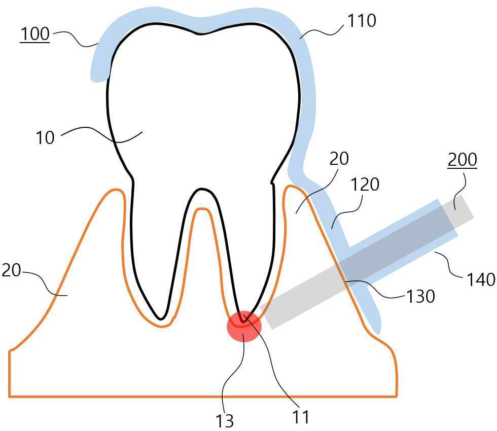 이미지의 다중 중첩분석을 통해 가이드 홀 위치가 결정되는 치아 가이드 탬플릿 및 이를 이용한 치근단 절제장치 대표 이미지