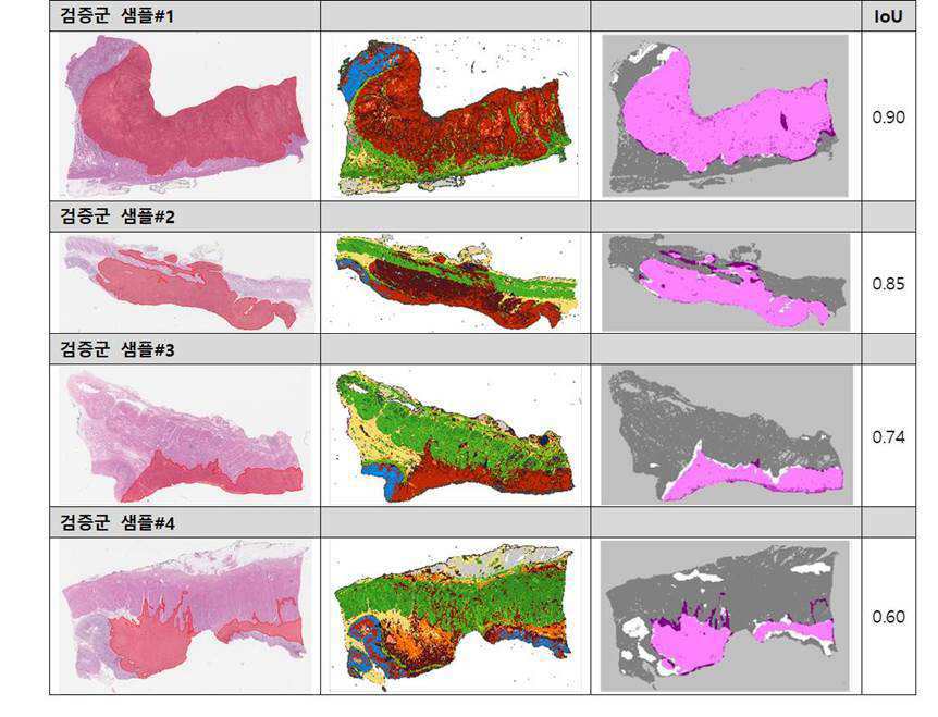 위암 병리조직 이미지 판독 인공지능 소프트웨어 대표 이미지